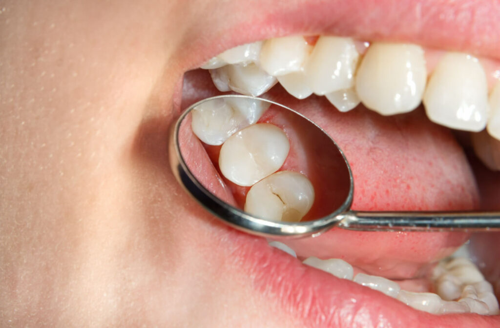 A close-up of a patient's mouth shows cavities forming in a tooth.